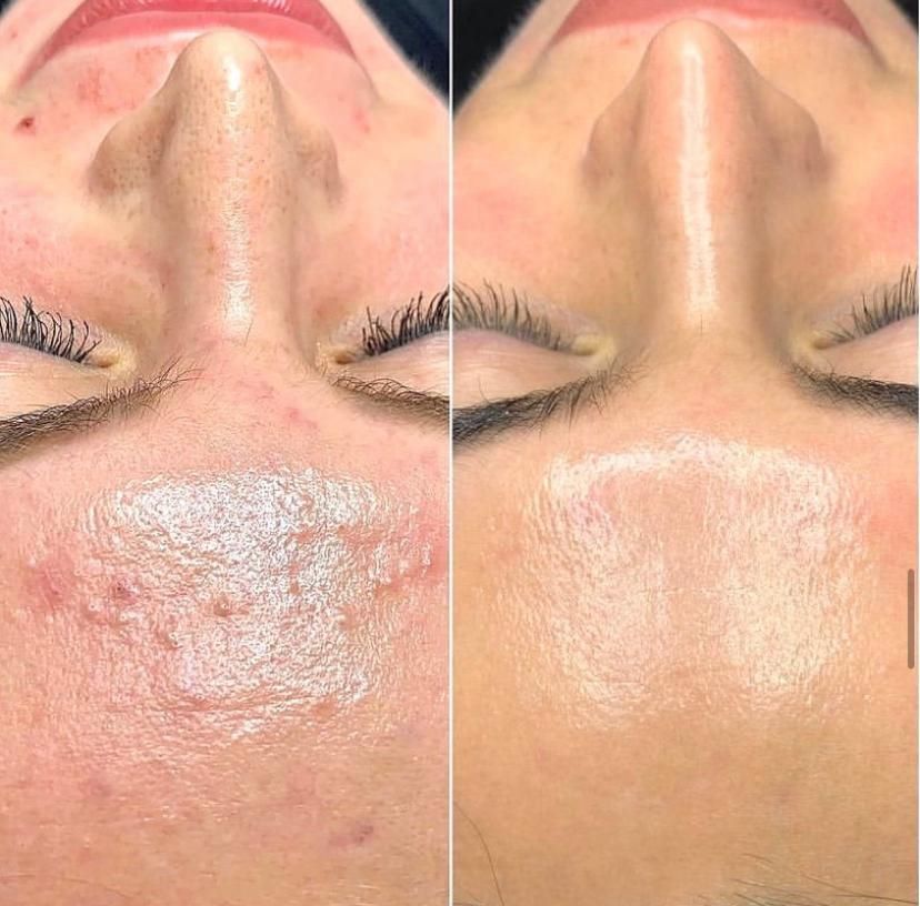 Biorepeel Before & After 1