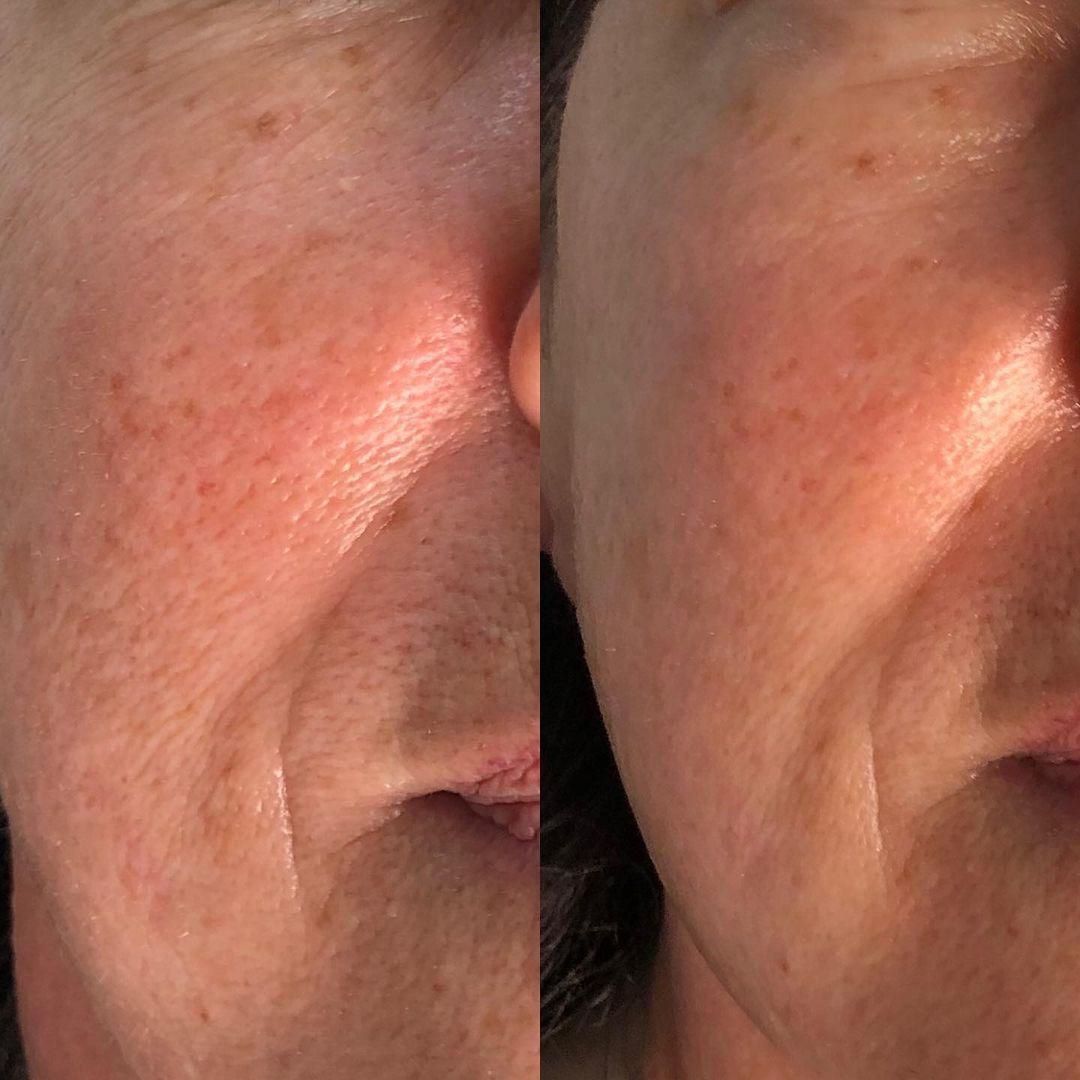 Biorepeel Before & After 2