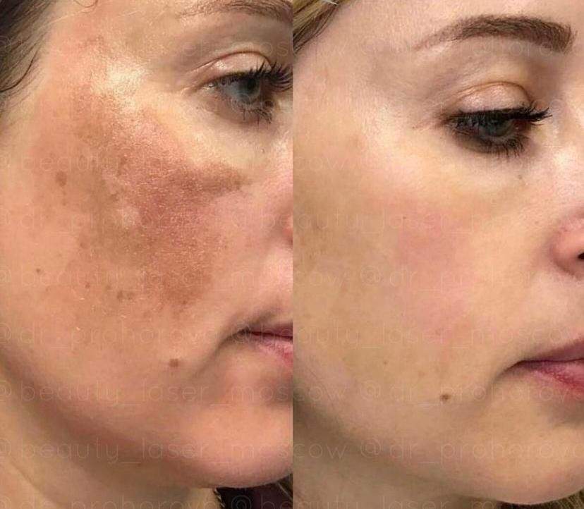 Biorepeel Before & After 3