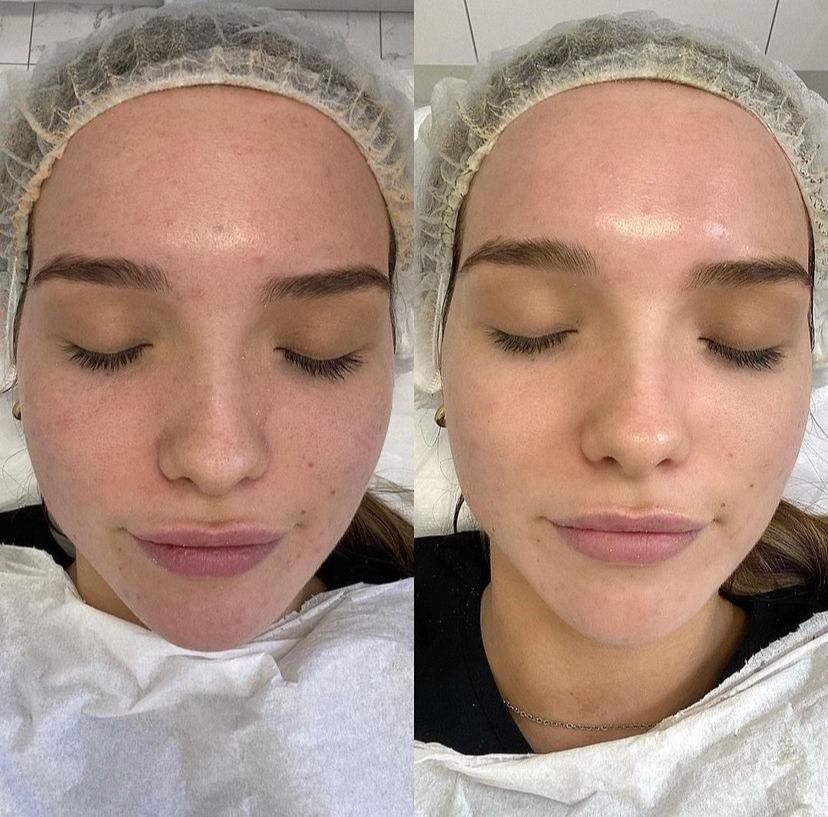 Biorepeel Before & After 4